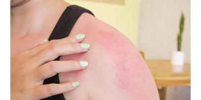 Chiazze rosse, prurito e secchezza della pelle possono essere dei sintomi dell'allergia
