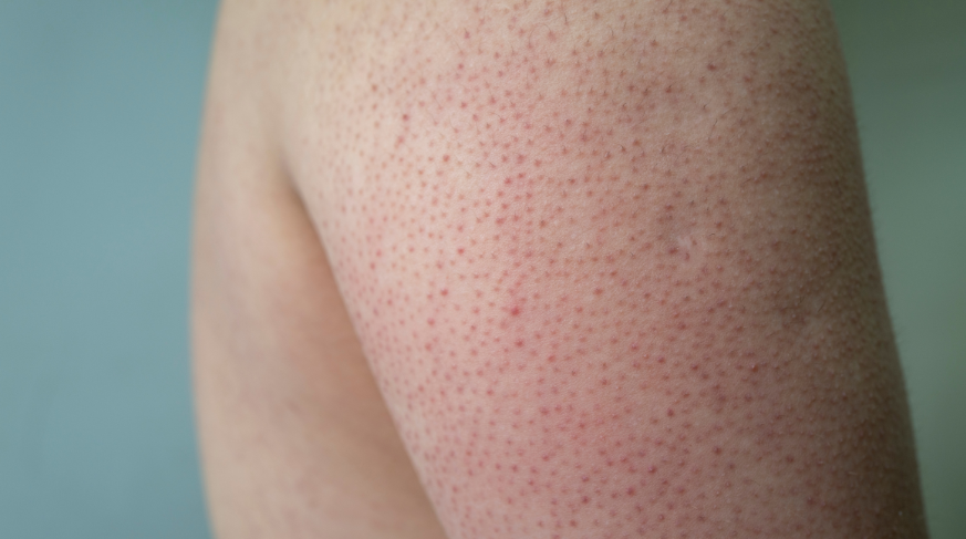 Pelle di fragola o cheratosi pilare, perché si presenta e come trattarla