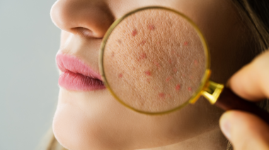 Come rinforzare la barriera cutanea per avere una pelle meno reattiva, arrossata, sensibile