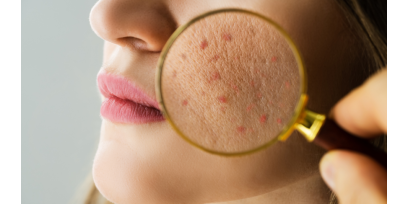 Come rinforzare la barriera cutanea per avere una pelle meno reattiva, arrossata, sensibile