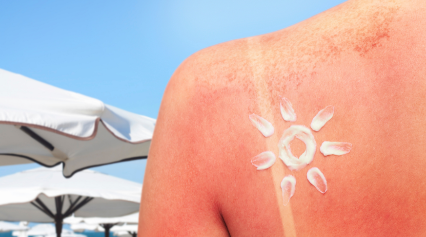 I migliori rimedi naturali per le scottature solari I migliori rimedi naturali per le scottature solari