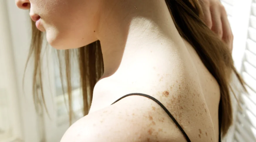 Cervicale e sbalzi di temperatura: tutti i consigli su come prevenire la cervicalgia e come trattarla