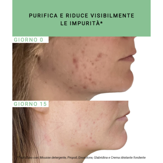 Etat Pur Propoli 750ppm - Attivo puro anti-imperfezioni per pelle acneica - 15 ml